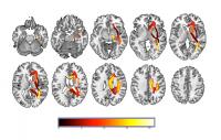 Evaluating the Utility of Applying Machine Learning to MRI Measures in Individuals with Major Depres