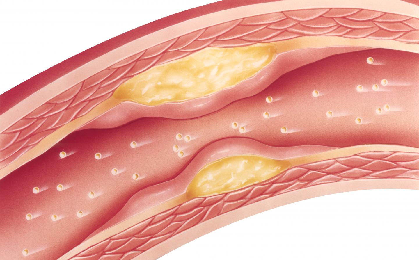 Statin Adherence