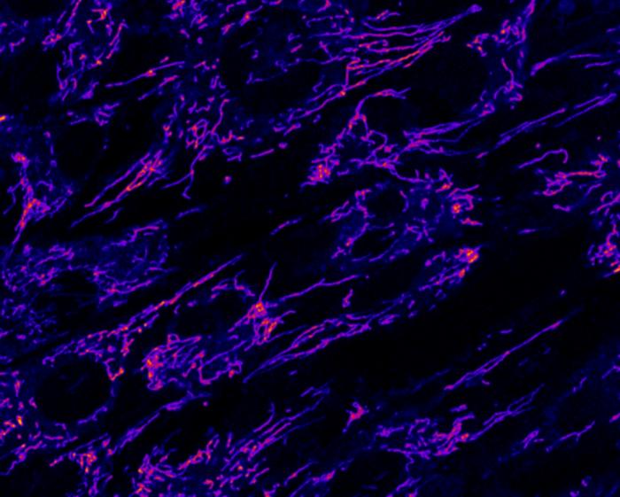 Mitochondria of TDD patient