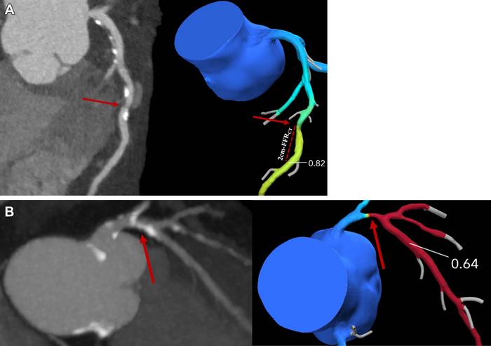 Coronary CT angiography images