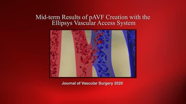 Mid-term Results of pAVF Creation with the Ellipsys Vascular Access System