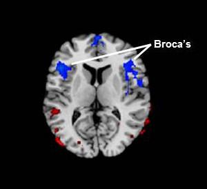 Broca's Area, Located in the Frontal Lobe of Brain