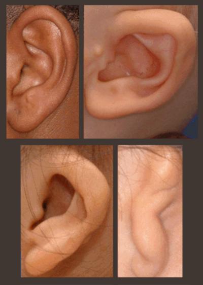 External Ear Malformation