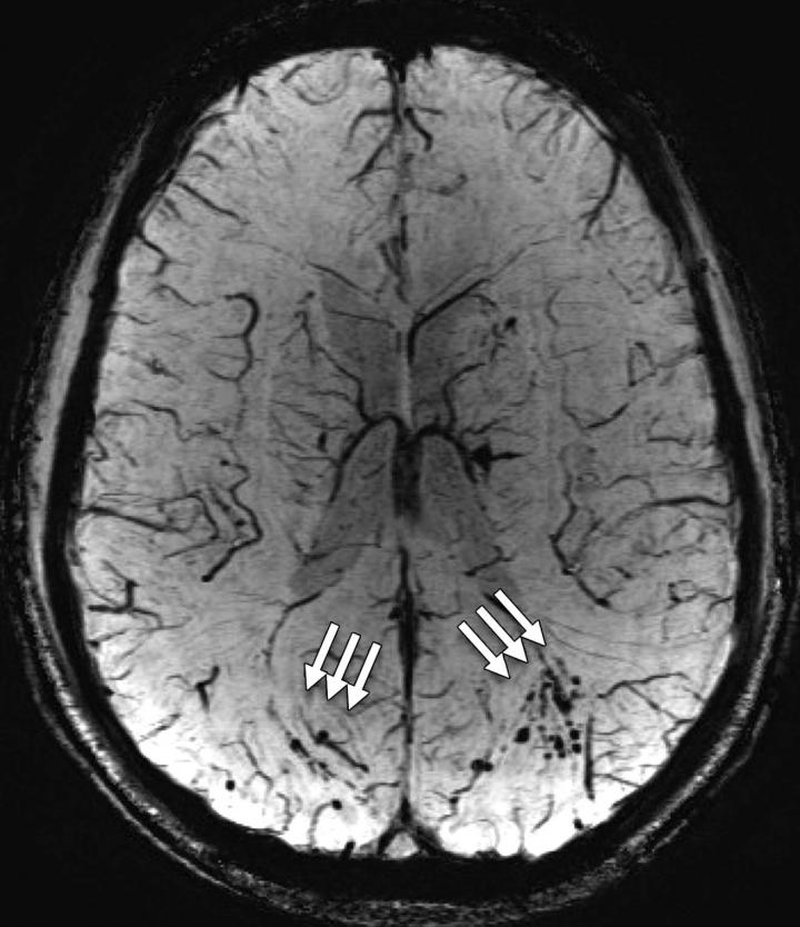 mri-shows-brain-scars-in-military-personnel-eurekalert