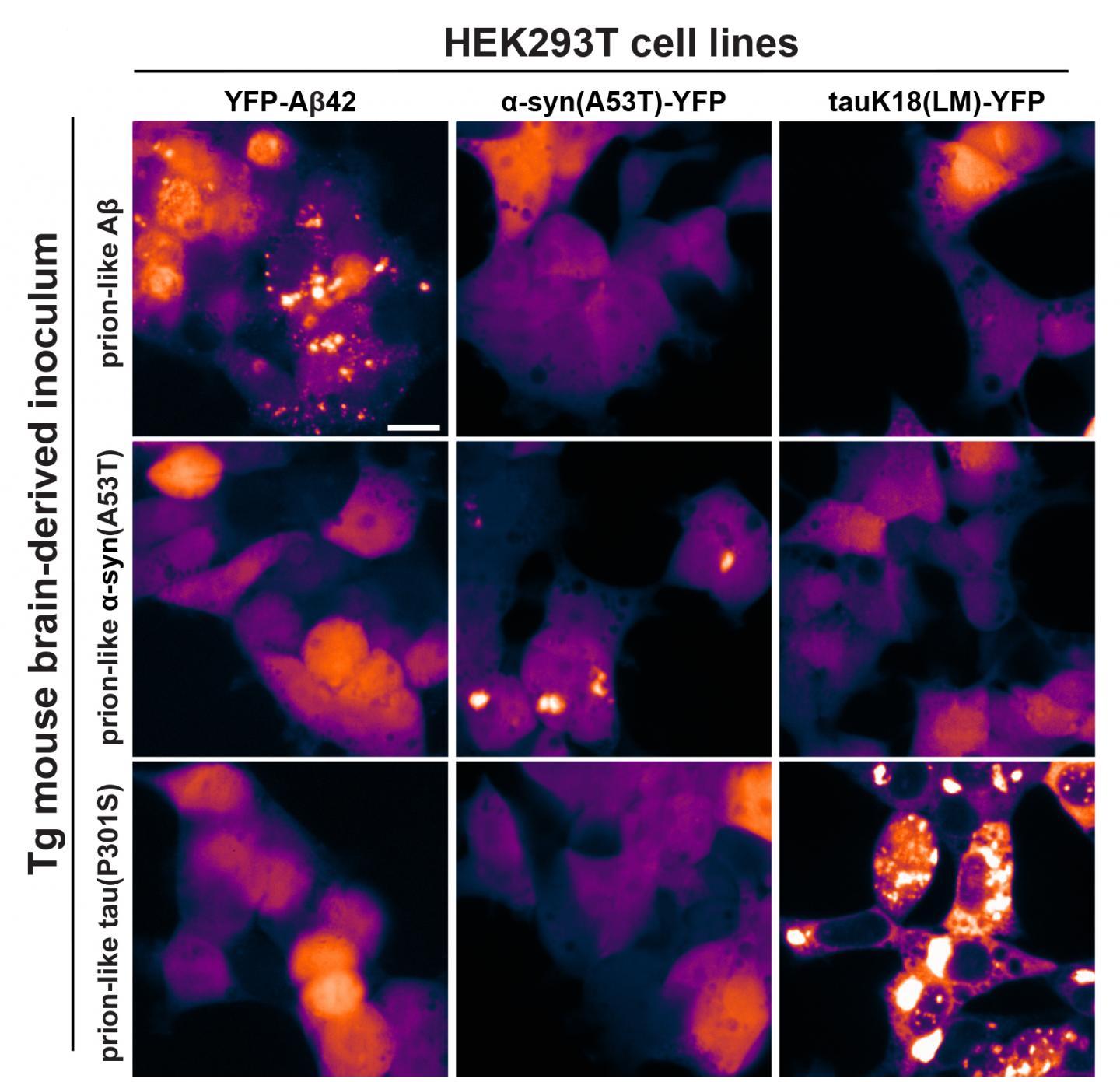 Harmful Misfolded Proteins Decline with Age in Alzheimer's Disease (1 of 1)