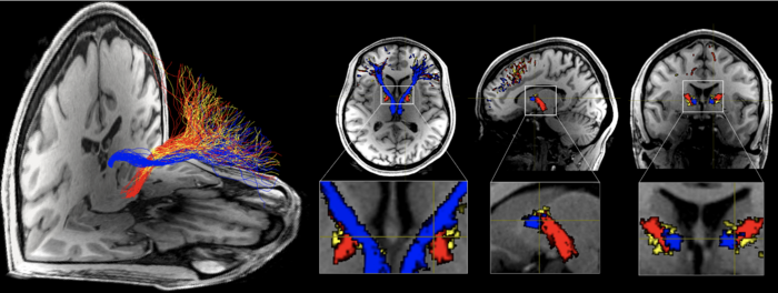 Rita Goldstein Neuron paper