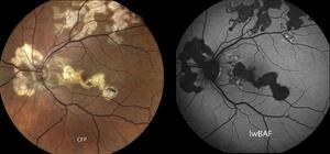 Simplified diagnosis of rare eye diseases