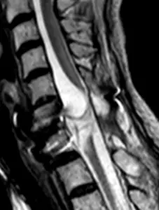 Severe acute spinal cord injury in the area of the cervical spine.