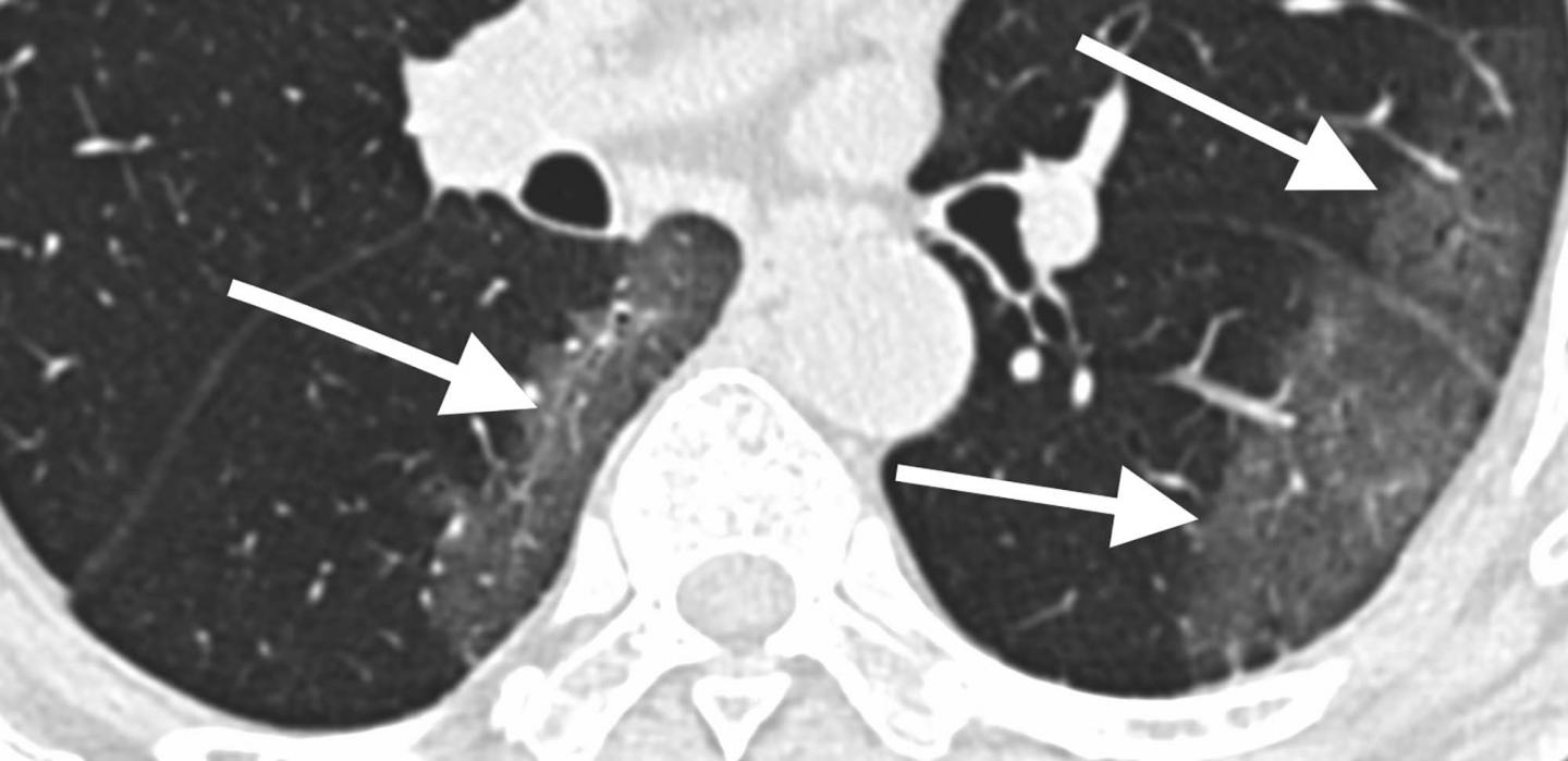 Radiologists Describe Coronavirus Imaging Features