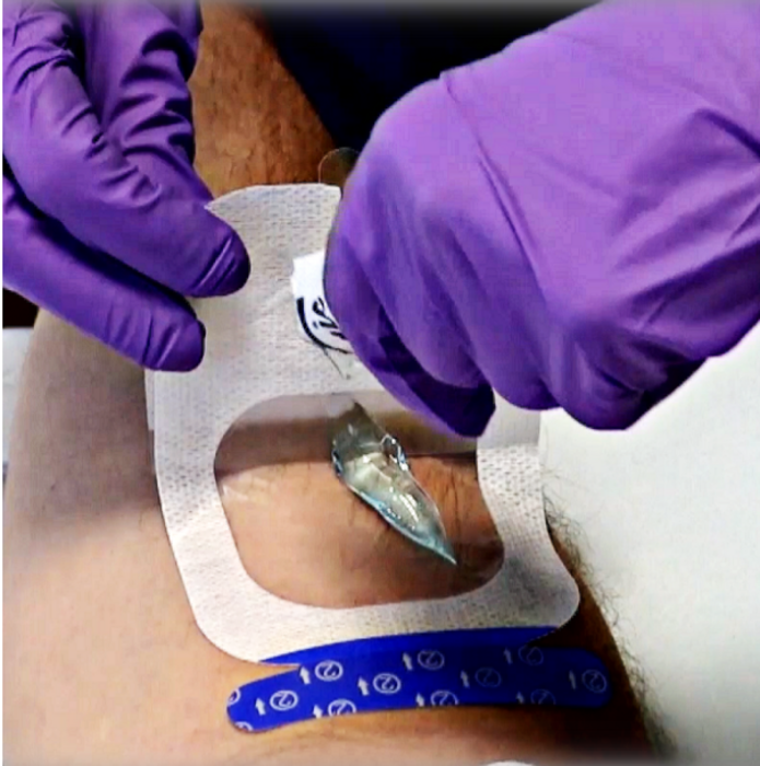 UltraDrape Minimizes UGPIV Risks - Image 2