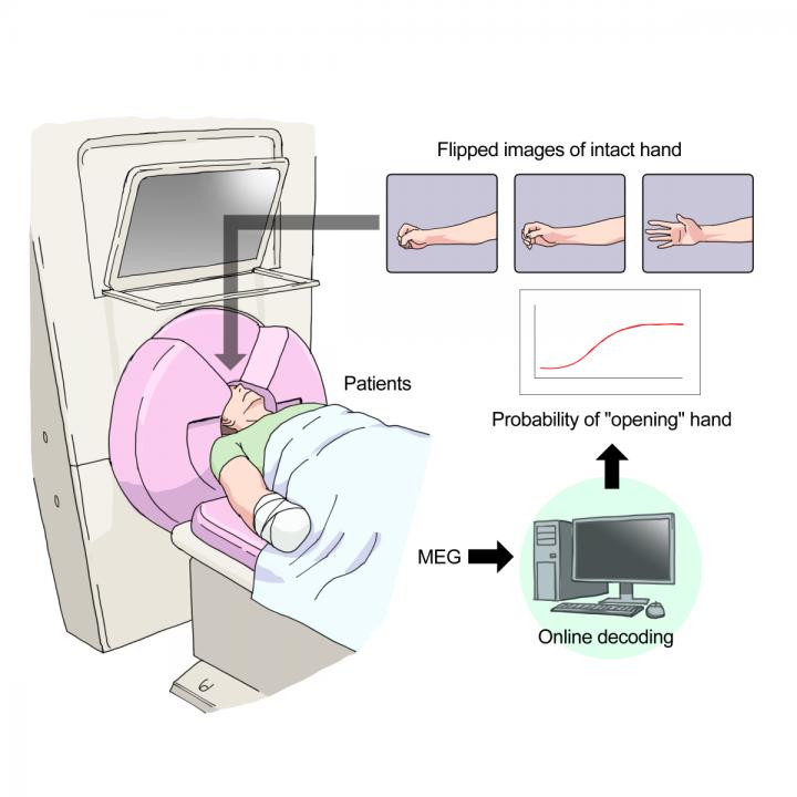 Figure 1: MEG-BCI treatment of phantom limb pain