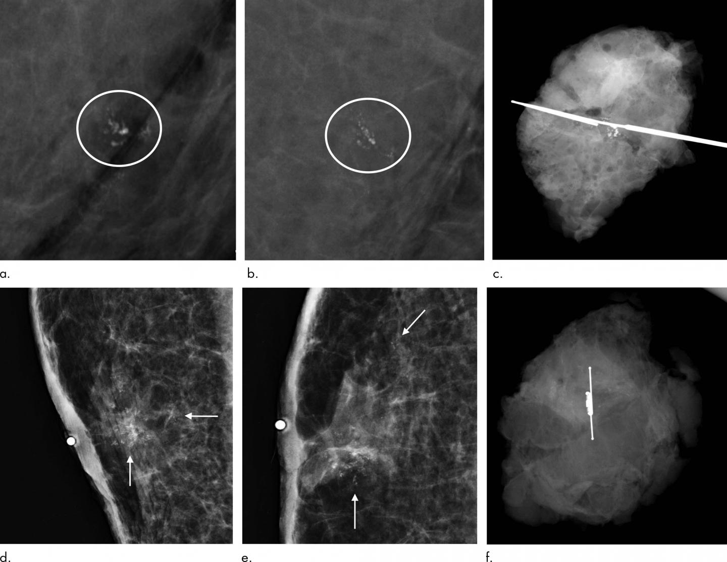 Screening Mammography Could Benefit Men at High Risk of Breast Cancer