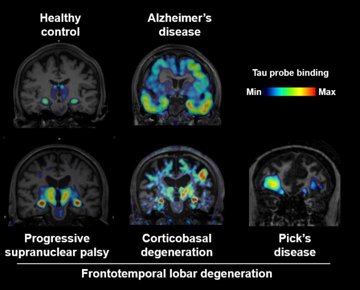PET Imaging of AD - Coronal