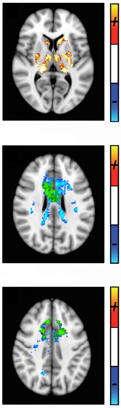 Quantitative Susceptibility MRI Developed to Track MS