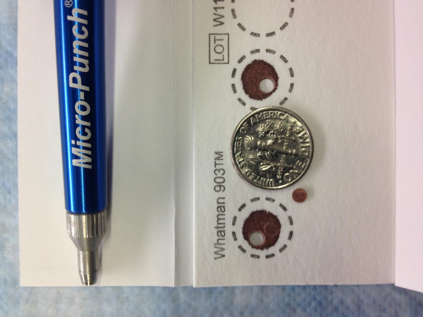 New blood spot test used internationally in f EurekAlert!