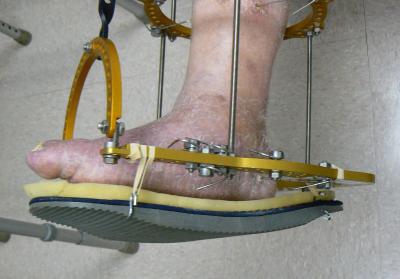Charcot Foot Surgery