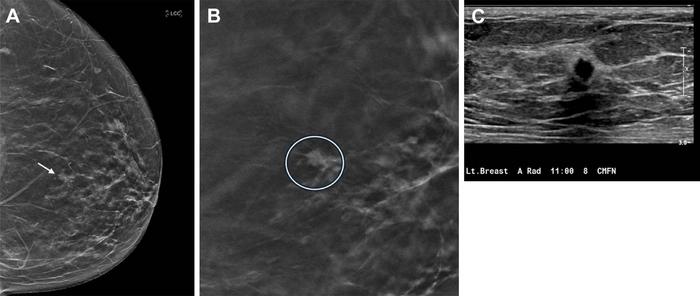 Images in a 67-year-old female patient who was recalled from screening for a small focal asymmetry in the left breast.