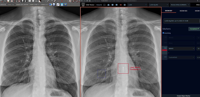 (Left) The standard clinical PACS (Picture archiving and communication system) frontal chest X-ray image, which does not detect/identify LLIED. (Right) ZF GUI/Viewer display of 12-class AI model inference result on the same monitor.