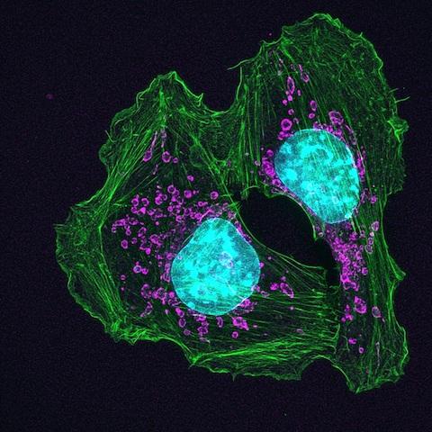 Skin Cancer Cell