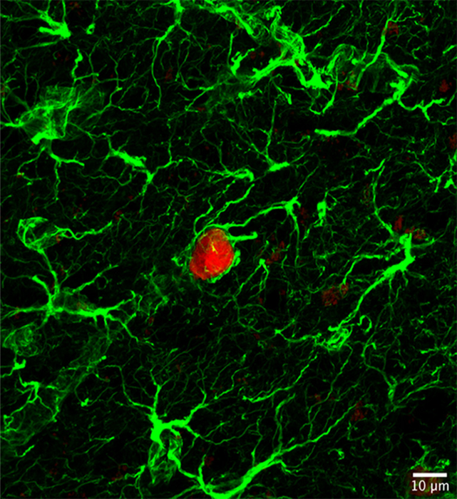 Prostate Cancer Cell