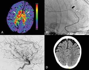 Thrombectomy Comparable to Medical Management for Strokes