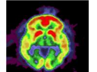 Amyloid Deposits in Brain