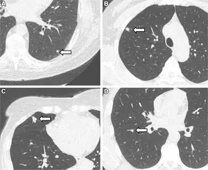 Representative chest low-dose CT images show lung nodules (arrows)