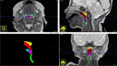 Preterm Infants Have Narrowed Upper Airways