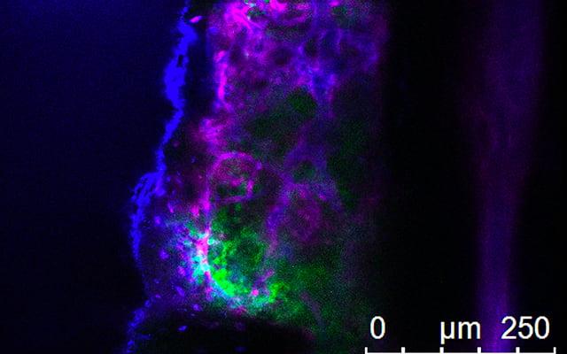 Leukemia Cells in Bone Marrow, University of California San Diego