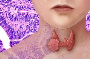 Global burden of thyroid cancer (TC) is predicted to increase by 34.15% in 2050