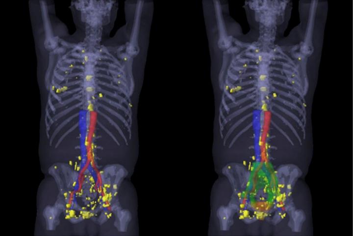 A 3-dimensional Map of the PSMA-positive Lesions Outside the Standard Radiation Fields