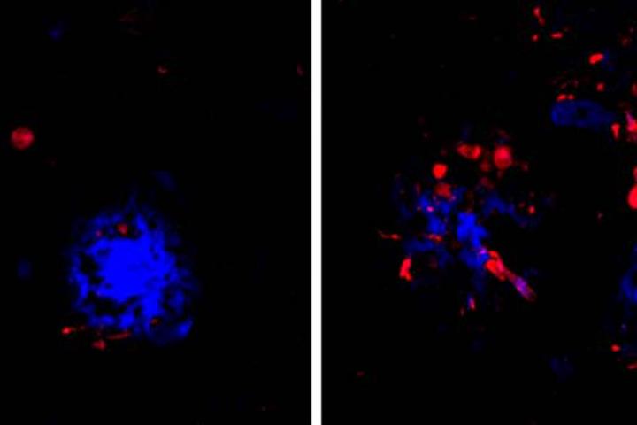 Amyloid and Tau