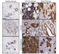 Chemical Hallmarks of Residual Breast Cancer Cells