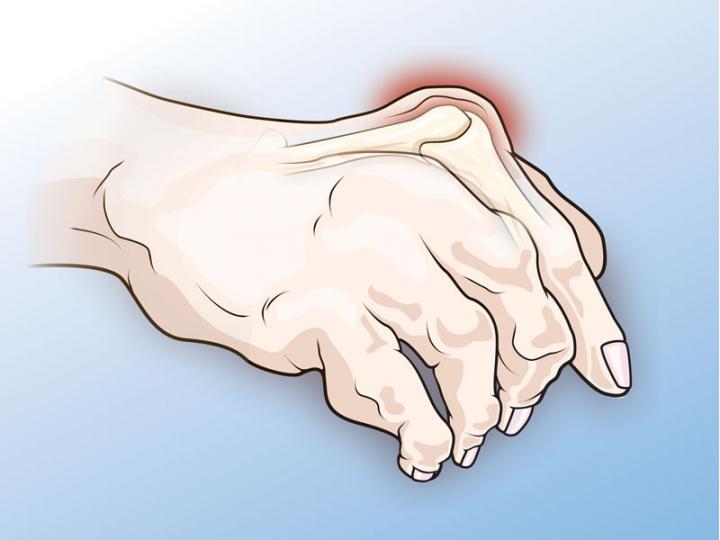 Prooxidants May Fix Metabolic Defect in Arthritis-Driving T Cells *free* (1 of 1)