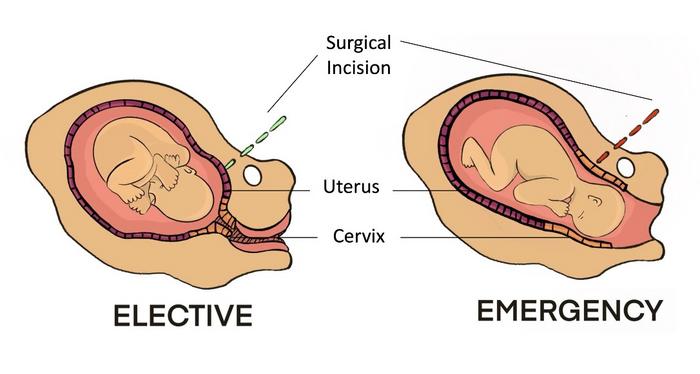 Cesarean sections during labor appear associated with recurrent preterm birth and mid-trimester loss in subsequent pregnancies, and cervical damage may be an underlying mechanism, suggest the authors of a new Perspective article