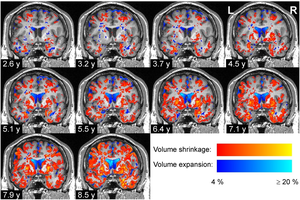 Degeneration of brain tissue