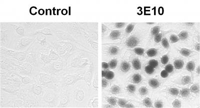 Could Lupus Antibodies Treat Cancer?