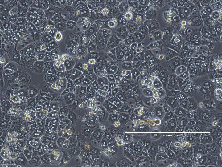 Hepatitis C in Liver Cells