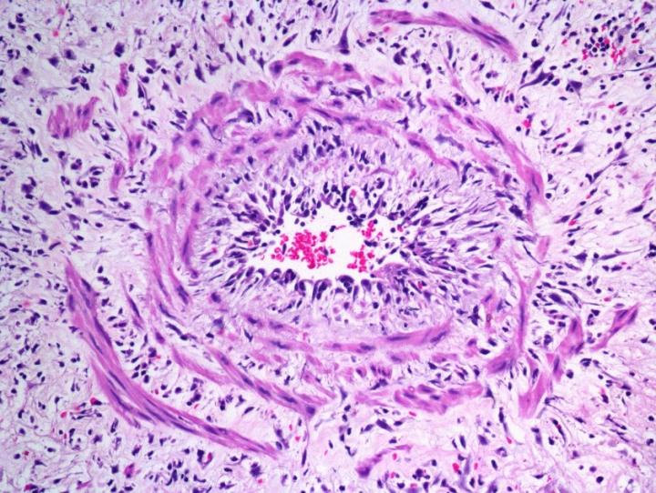 Researchers Characterize Unusual Blood Clots in Leprosy Patients