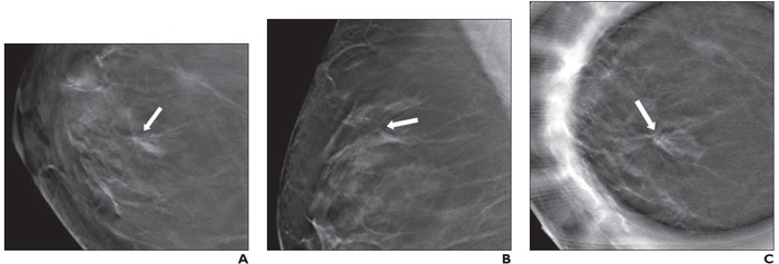 49-Year-Old Woman Presenting for Screening Mammography, Revealing Right Breast Architectural Distortion