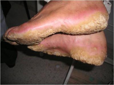 Lesions of Palmoplantar Keratoderma (PKK) on the Soles