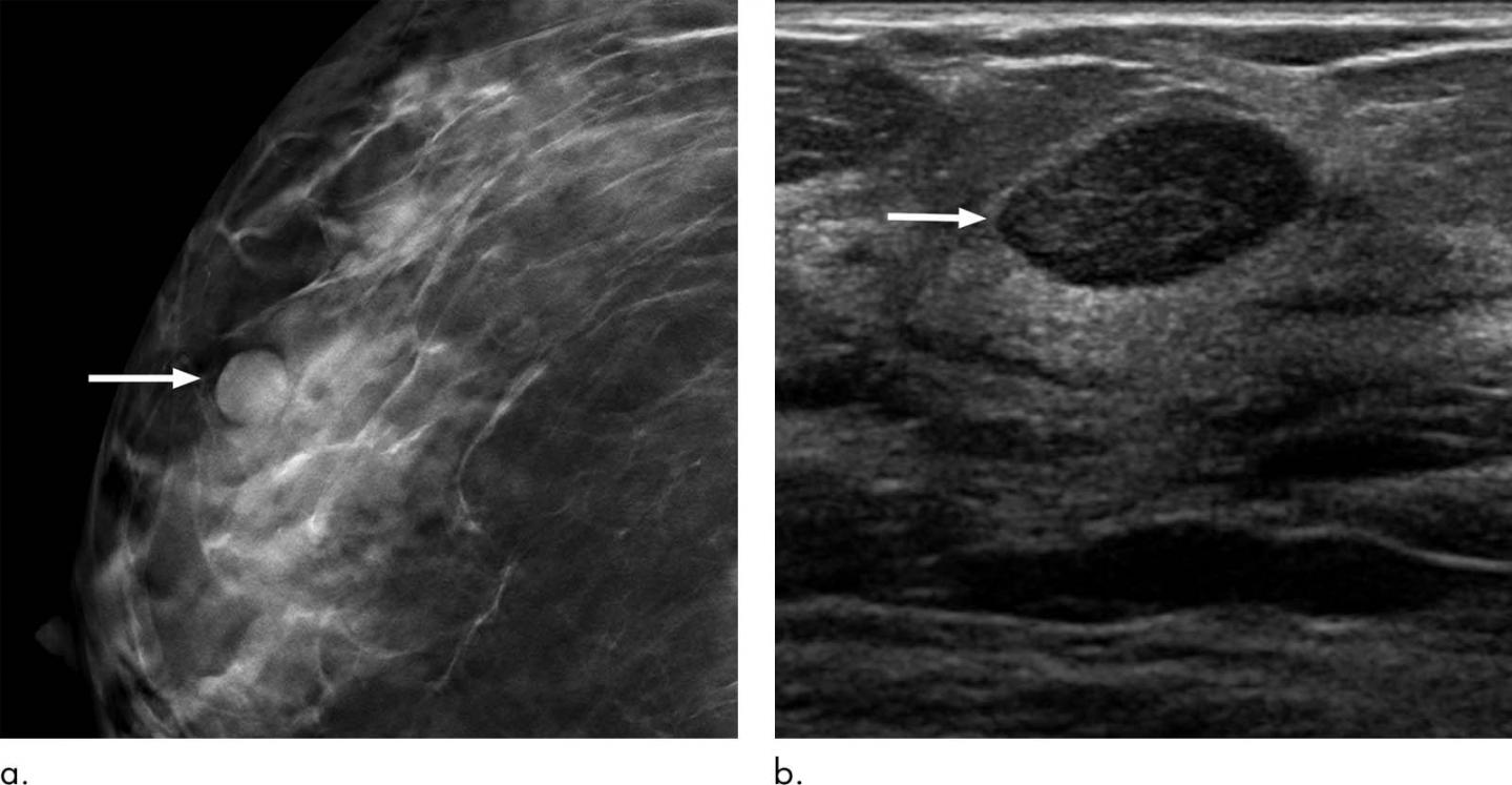 Six-month Follow-up Appropriate for BI-RADS 3 Findings on Mammography