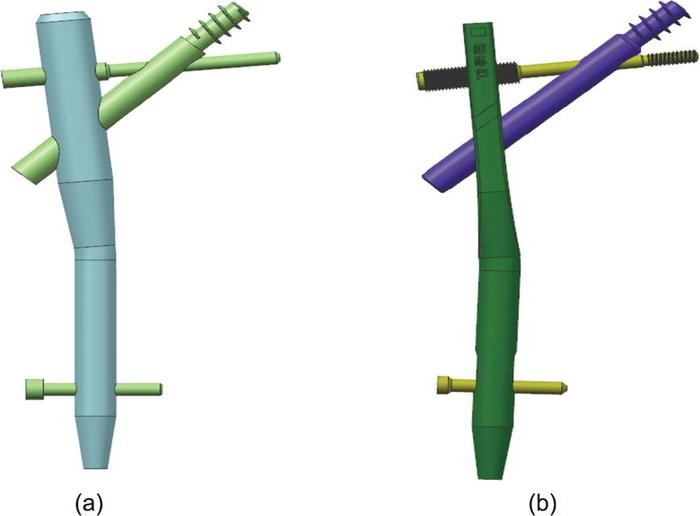 Schematic of (a) the proximal femur bionic nail (PFBN) and (b) its modified version for preventing bone nonunion, Yingze nail.