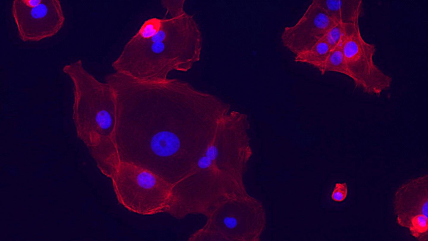 Epithelial Cell Lung Tumors