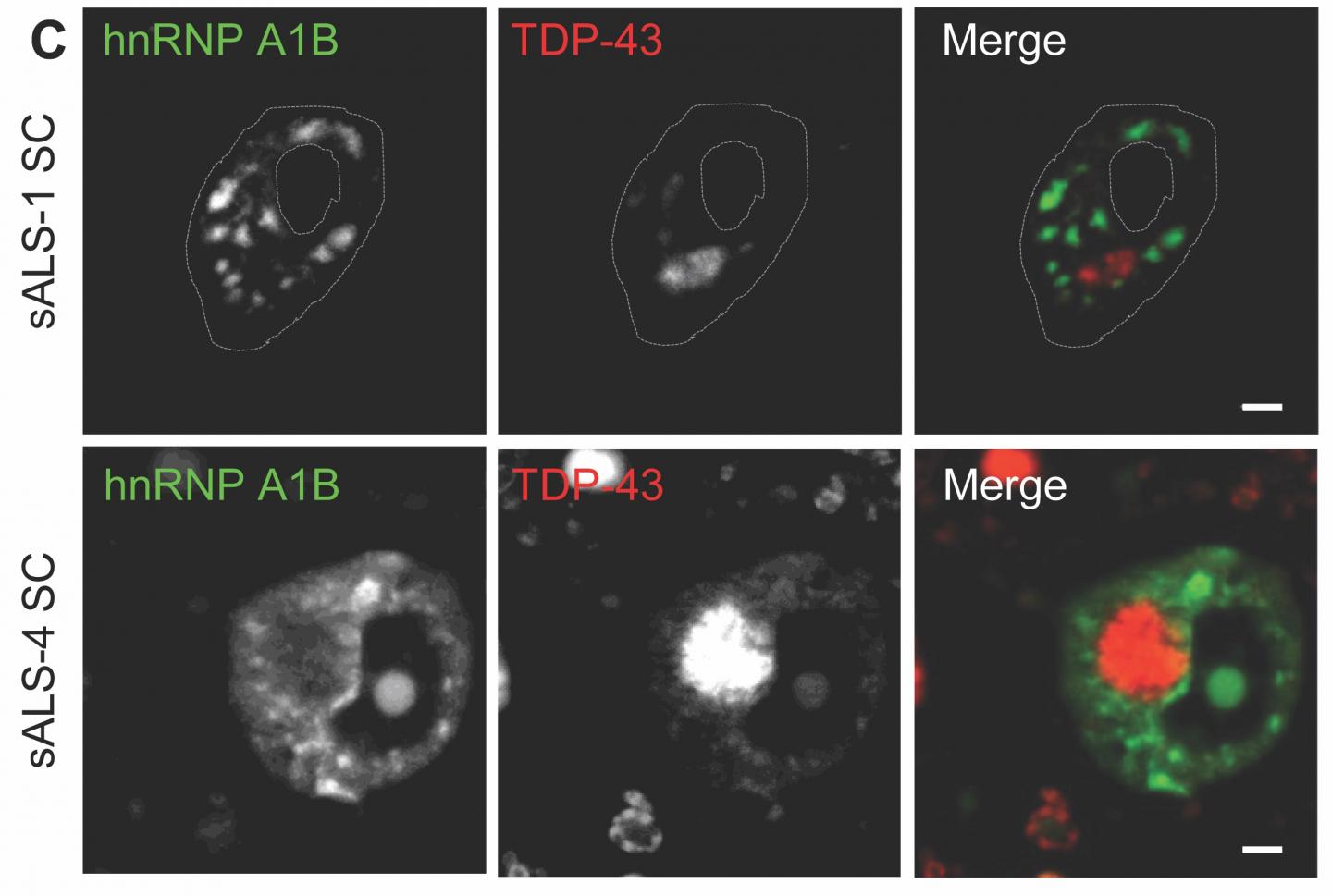 hnRNP A1B is Expressed in the CNS and Forms Cytoplasmic Aggregates in ALS Patient Neurons
