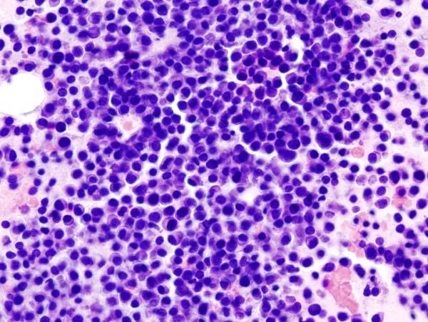 Myeloma HE Stain