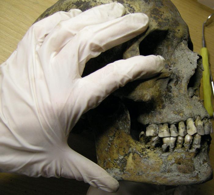 Caries prevalence and other dental pathological conditions in Vikings from Varnhem, Sweden