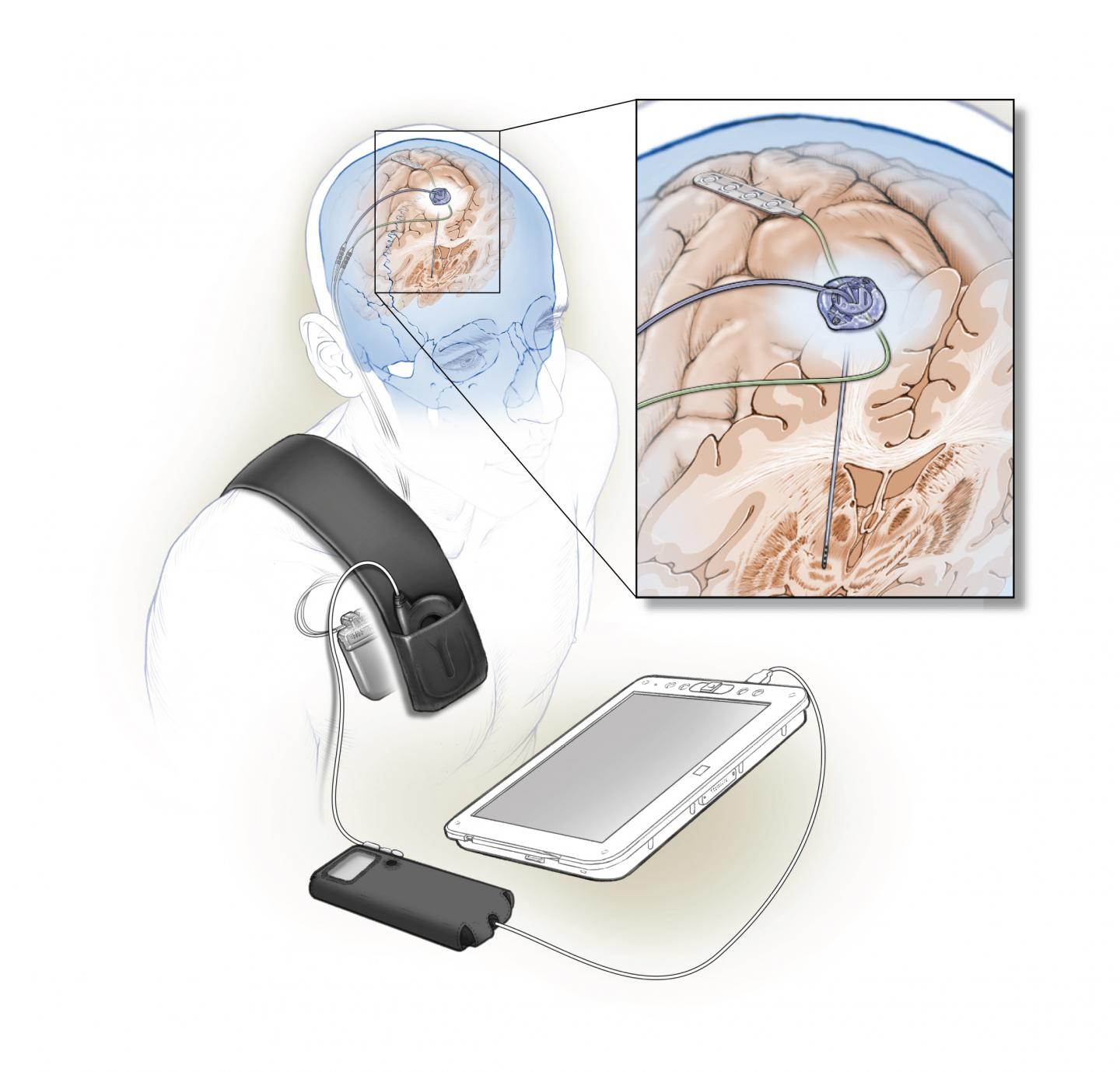 Fully-implanted Adaptive DBS System