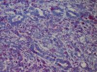 Mouse Pancreatic Tumor Expresses SOAT1