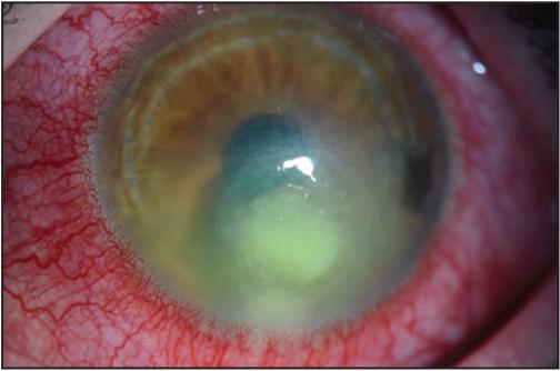 Corneal Infection